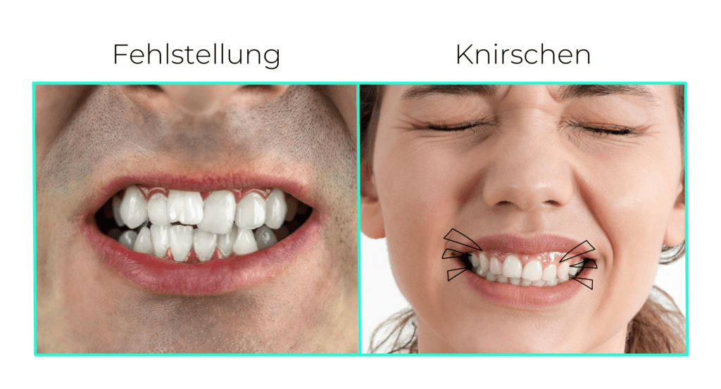 Schiefe Zähne und Zähne knirschen